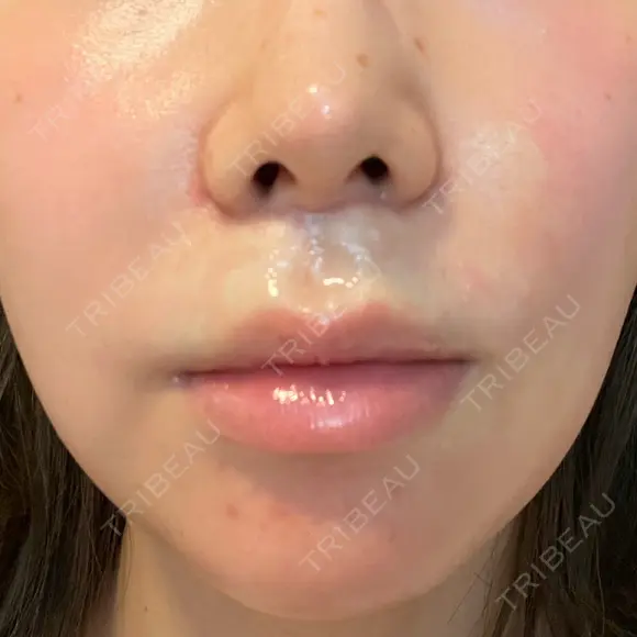 人中短縮 聖心美容クリニック 六本木院 DAY 41 メイン用