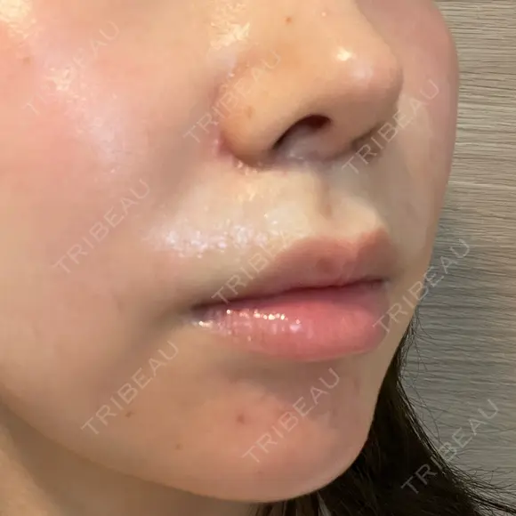 人中短縮 聖心美容クリニック 六本木院 DAY 41 メイン用