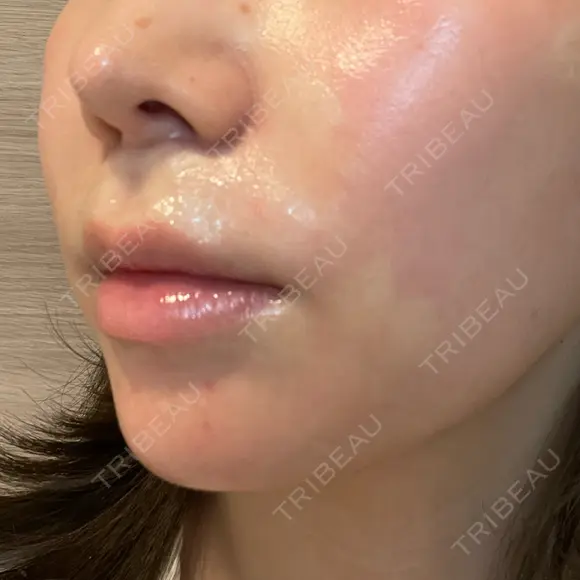 人中短縮 聖心美容クリニック 六本木院 DAY 41 メイン用
