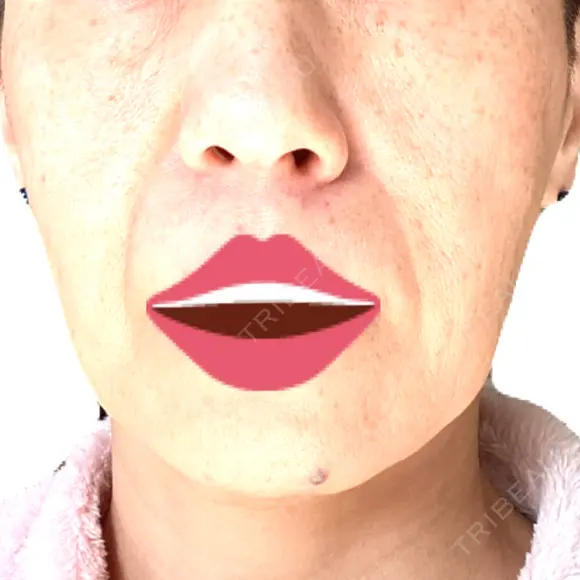 ボトックス（エラ・小顔） / ヒアルロン酸注入（頬） 新未来クリニック DAY 7 メイン用