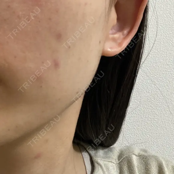 水光注射（ハリ・美肌） Rinato Beauty Clinic DAY 1 メイン用