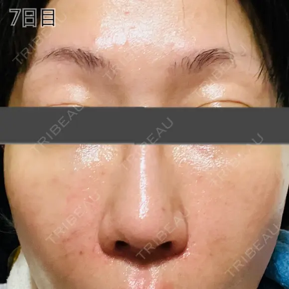 肌育注射（ジュベルックなど） / リジュラン 新宿Ladies&Gentlemen美容クリニック DAY 7 メイン用