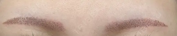 アートメイク（眉） Tokyo Tensei Clinic 新宿院 DAY 0 メイン用