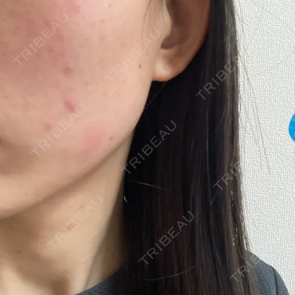 水光注射（ハリ・美肌） Rinato Beauty Clinic DAY 2 メイン用