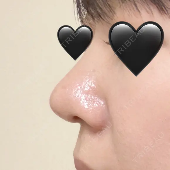 隆鼻術 / 鼻尖形成（切開） / 鼻中隔延長（切開） / 軟骨移植 / 骨切幅寄せ / 鼻翼基部形成（貴族手術） / 鼻柱下降・鼻唇角形成（猫手術） 4Dクリニック DAY 30 メイン用