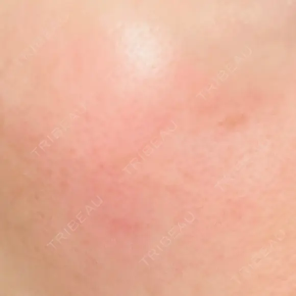 ニードルRF（ポテンツァなど） 広島プルミエクリニック AFTER メイン用