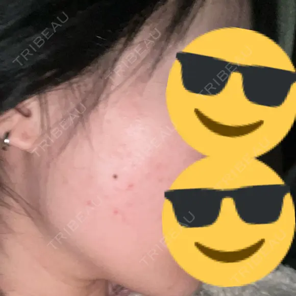 光治療（フォトフェイシャルなど） LUNA BEAUTY CLINIC 池袋駅前院 DAY 1 メイン用