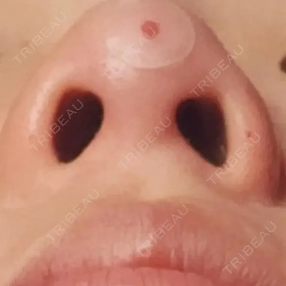 ヒアルロン酸注入（鼻） / ヒアルロン酸注入（鼻翼基部） プロジェクトユー医院 AFTER メイン用