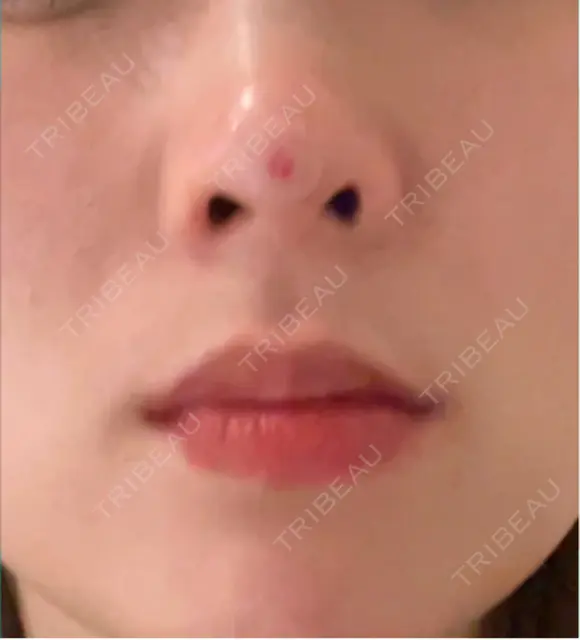 ヒアルロン酸注入（鼻） / ヒアルロン酸注入（鼻翼基部） プロジェクトユー医院 DAY 2 メイン用