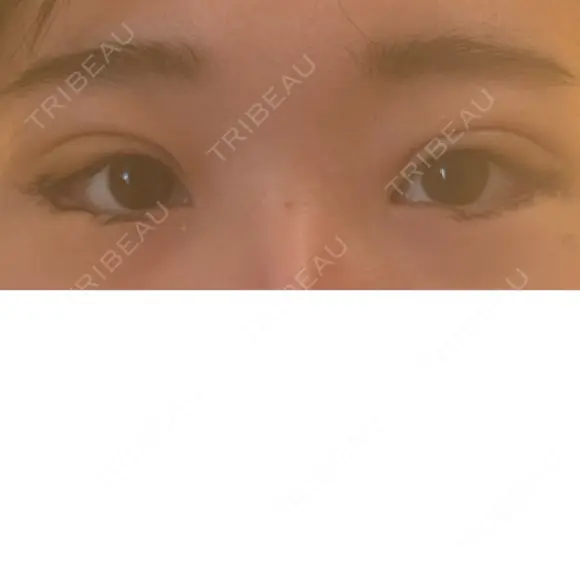 二重埋没 / 目尻切開 / タレ目形成・グラマラスライン（切開） YBC横浜美容外科 池袋院 DAY 4 メイン用