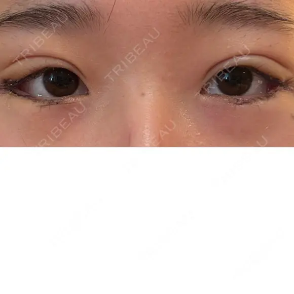 二重埋没 / 目尻切開 / タレ目形成・グラマラスライン（切開） YBC横浜美容外科 池袋院 DAY 6 メイン用