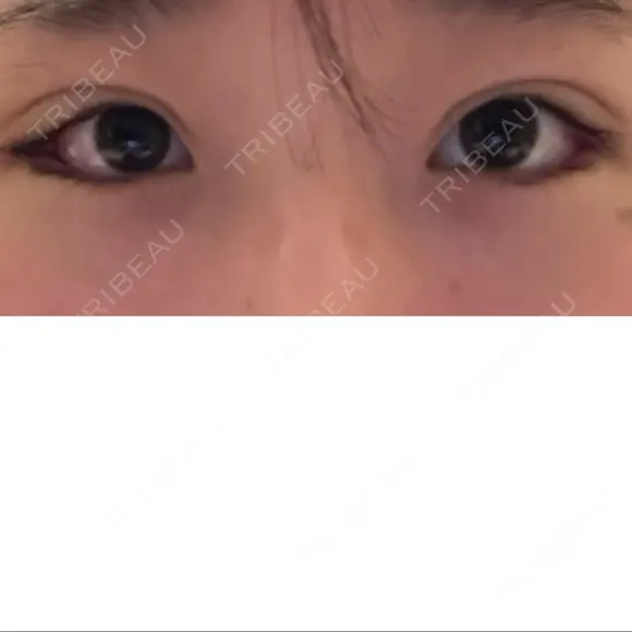 二重埋没 / 目尻切開 / タレ目形成・グラマラスライン（切開） YBC横浜美容外科 池袋院 DAY 8 メイン用