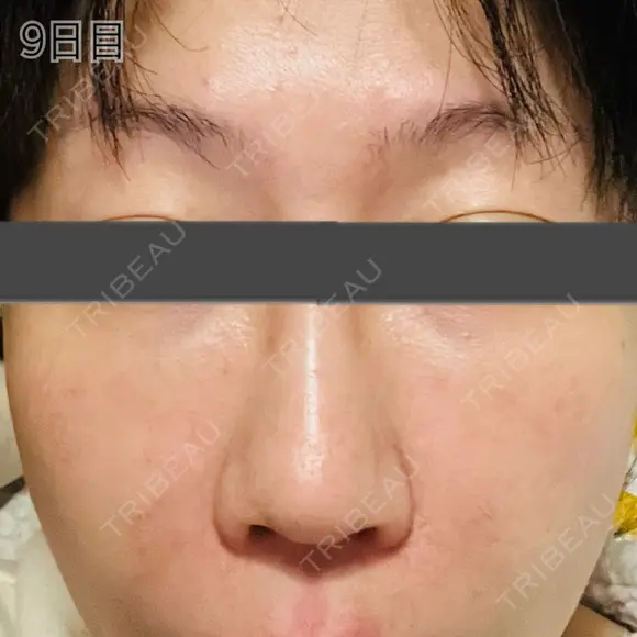 肌育注射（ジュベルックなど） / リジュラン 新宿Ladies&Gentlemen美容クリニック DAY 9 メイン用