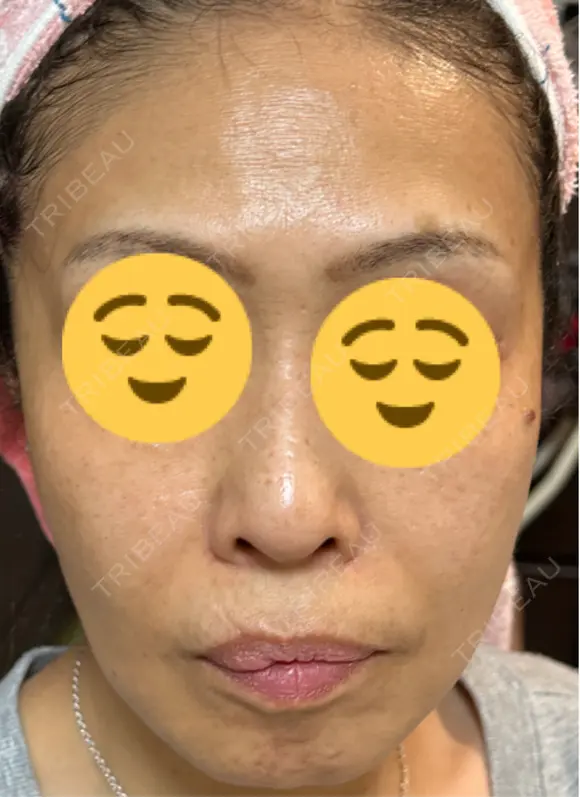 ピコレーザートーニング（美白・肝斑） / フラクショナルレーザー（毛穴・ニキビ跡） Mavie Beauty Clinic （マヴィービューティークリニック） AFTER メイン用