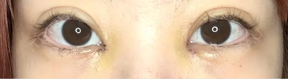 目頭切開 9BeautyClinic DAY 3 メイン用
