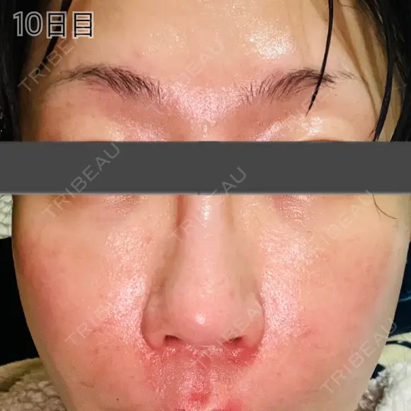 肌育注射（ジュベルックなど） / リジュラン 新宿Ladies&Gentlemen美容クリニック AFTER メイン用