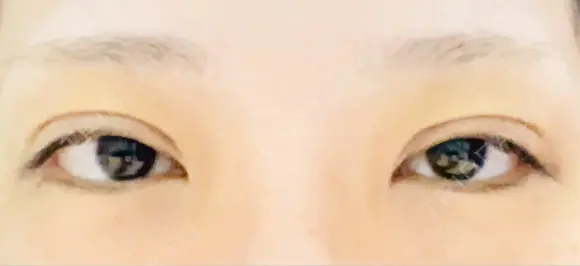 二重埋没 / 上まぶたの脂肪取り / ボトックス（額） 9BeautyClinic AFTER メイン用