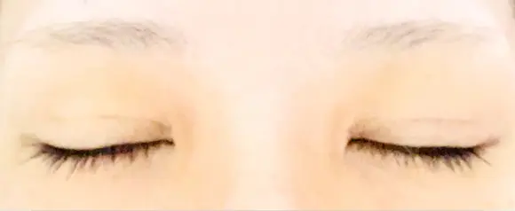 二重埋没 / 上まぶたの脂肪取り / ボトックス（額） 9BeautyClinic DAY 31 メイン用