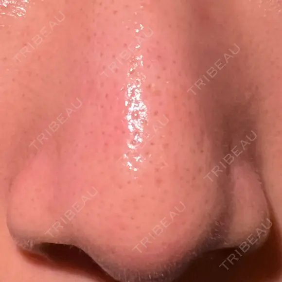 アグネス 日本美容・医療クリニック 六本木院 DAY 0 メイン用