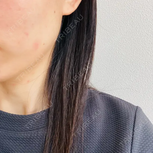 水光注射（ハリ・美肌） Rinato Beauty Clinic AFTER メイン用