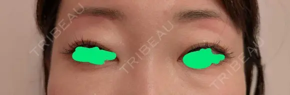 眉下切開 Barbie Clinic AFTER メイン用