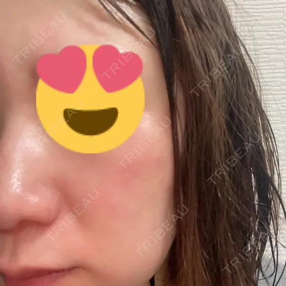 美容点滴・美容注射（美肌） Kinshicho Beauty Clinic （錦糸町ビューティークリニック） AFTER メイン用