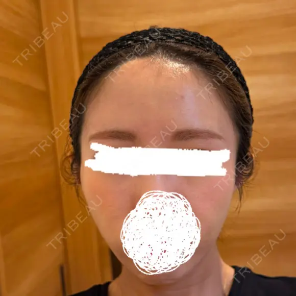 脂肪注入（額） EMMA CLINIC（エマクリニック） DAY 31 メイン用