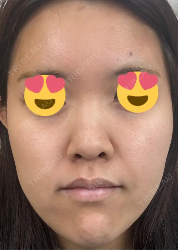 医療脱毛（顔） 日本美容・医療クリニック 六本木院 DAY 14 メイン用