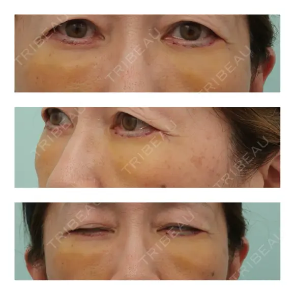 下まぶたたるみ取り WOM CLINIC GINZA （ワム クリニック ギンザ） DAY 6 メイン用