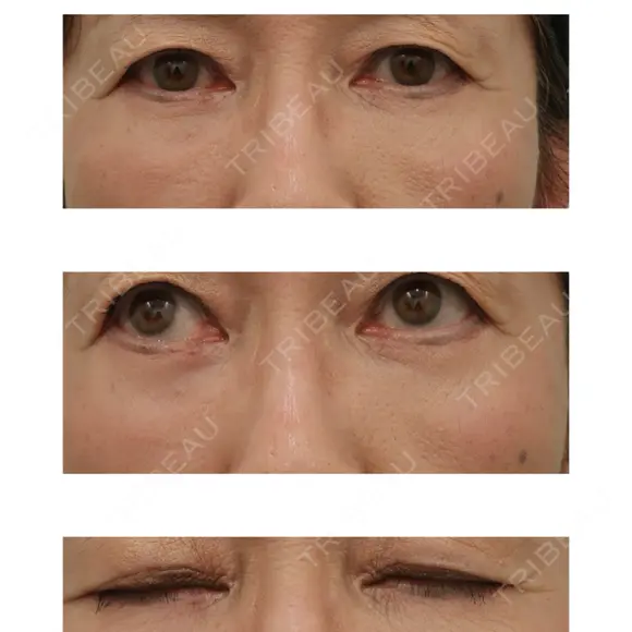 下まぶたたるみ取り WOM CLINIC GINZA （ワム クリニック ギンザ） AFTER メイン用