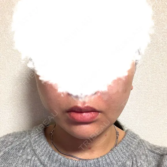 糸リフト / 脂肪吸引（顔） EMMA CLINIC（エマクリニック） DAY 31 メイン用