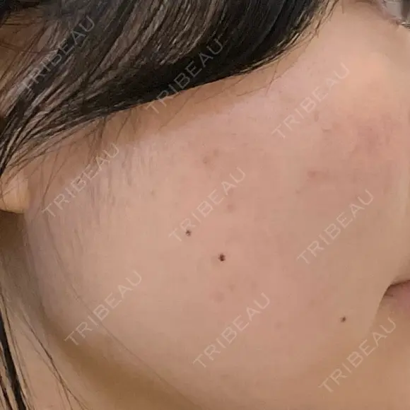 光治療（フォトフェイシャルなど） LUNA BEAUTY CLINIC 池袋駅前院 DAY 4 メイン用
