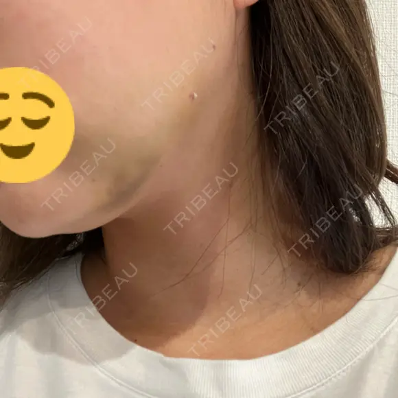 脂肪吸引（顔） PRISM Beauty Clinic 町田院 DAY 3 メイン用