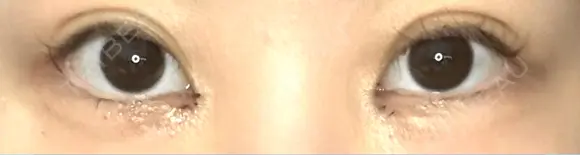 目頭切開 9BeautyClinic DAY 6 メイン用