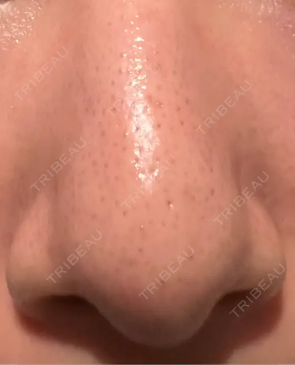 アグネス 日本美容・医療クリニック 六本木院 DAY 4 メイン用