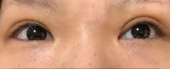 眼瞼下垂（切開） 東京皮膚科・形成外科 (銀座いけだクリニック) DAY 17 メイン用