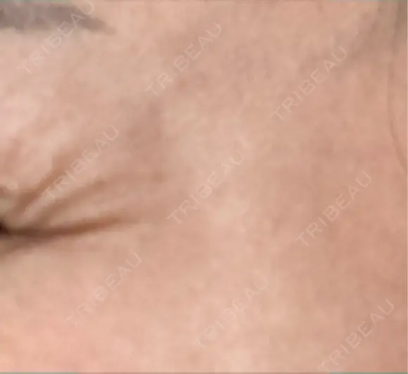 ボトックス（目尻） / ボトックス（額） 東京美容医療クリニック 池袋院 DAY 1 メイン用