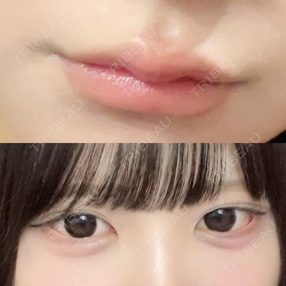 ヒアルロン酸注入（涙袋） / ヒアルロン酸注入（唇） HAAB×DREAM BEAUTY CLINIC 大阪梅田院 DAY 1 メイン用