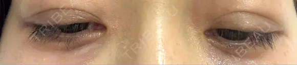 二重埋没 / クマ治療 / 下まぶたの脂肪取り / 脂肪注入（目の下） 湘南美容クリニック 西葛西院 DAY 38 メイン用