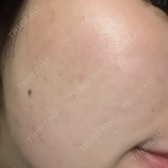 光治療（フォトフェイシャルなど） LUNA BEAUTY CLINIC 池袋駅前院 AFTER メイン用