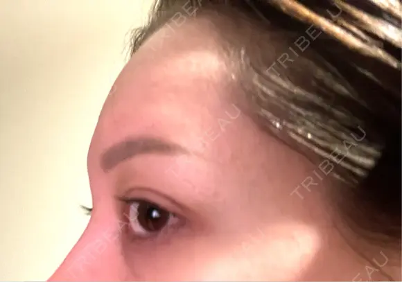 脂肪吸引（脚） / 豊胸（脂肪注入） / 脂肪注入（額） / ボトックス（額） Casa de GRACIA GINZA 【カーサデグラシアギンザ】 DAY 95 メイン用