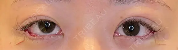 目尻切開 / タレ目形成・グラマラスライン（埋没） / 美容点滴・美容注射（美肌） LOUIS CLINIC 二子玉川院【ルイクリニック】 DAY 0 メイン用