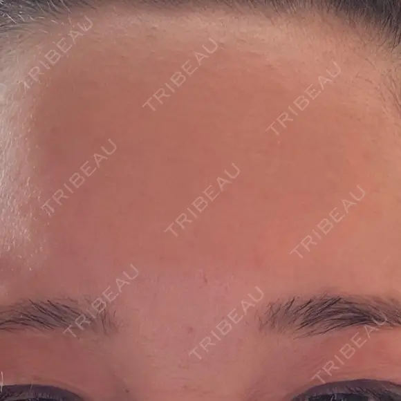 ボトックス（眉間） / ボトックス（額） / その他（鼻） TCB東京中央美容外科 盛岡院 DAY 2 メイン用