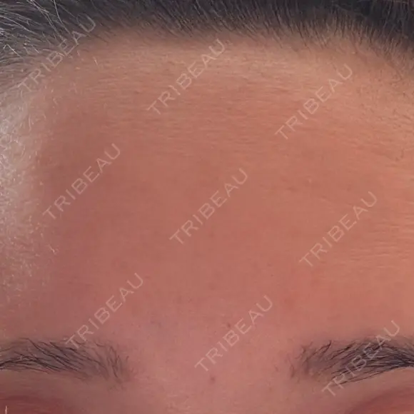 ボトックス（眉間） / ボトックス（額） / その他（鼻） TCB東京中央美容外科 盛岡院 AFTER メイン用