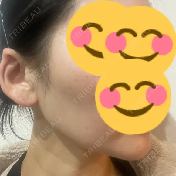 ボトックス（エラ・小顔） / ボトックス（額） TCB東京中央美容外科 長野院 AFTER メイン用