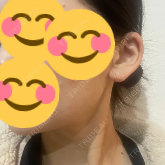 ボトックス（エラ・小顔） / ボトックス（額） TCB東京中央美容外科 長野院 DAY 4 メイン用