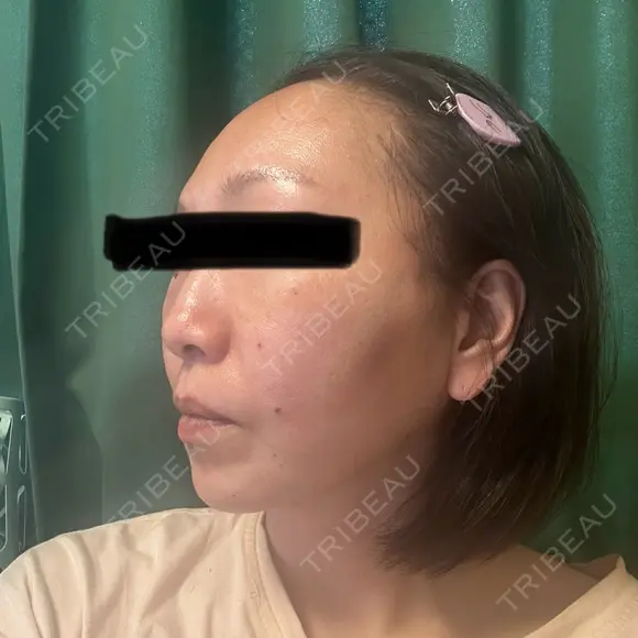 糸リフト / クマ治療 / 下まぶたの脂肪取り / 脂肪注入（肌） / こめかみ形成 / 脂肪注入（目の下） / ボトックス（あご） / ボトックス（首） 東京シンデレラ美容外科 池袋院 DAY 1 メイン用