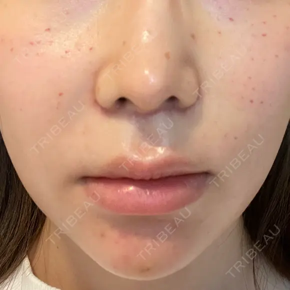 人中短縮 聖心美容クリニック 六本木院 DAY 50 メイン用
