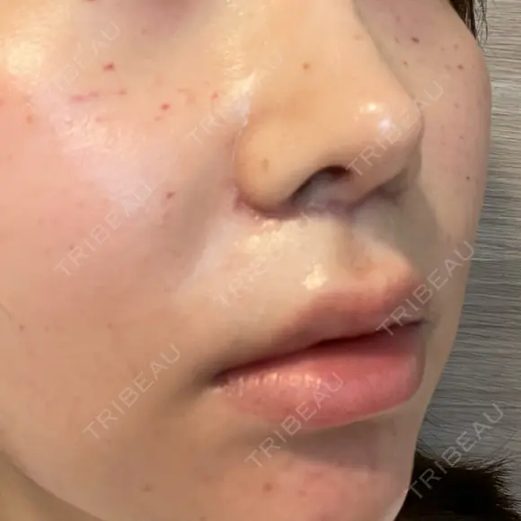 人中短縮 聖心美容クリニック 六本木院 DAY 50 メイン用