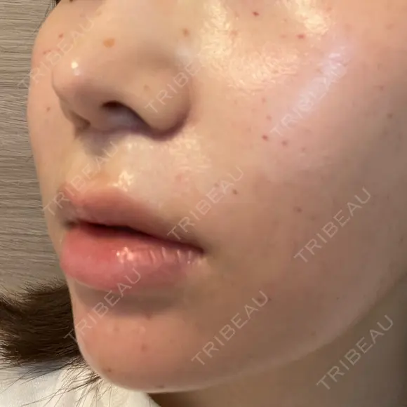 人中短縮 聖心美容クリニック 六本木院 DAY 50 メイン用